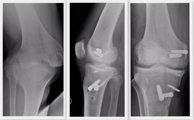 <h1>Primera reconstrucción ligamentaria múltiple de rodilla con injerto cadavérico en Mendoza</h1>
<p>El 26 de marzo de este año se realizó la primera reconstrucción ligamentaria múltiple con utilización de injerto cadavérico, en un paciente con una luxación de rodilla y lesiones ligamentarias severas.</p>
<p><a href=